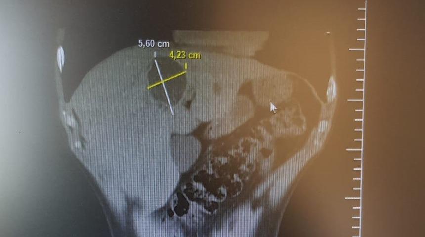 Karaciğerideki kistten 3 saatlik operasyonla kurtuldu