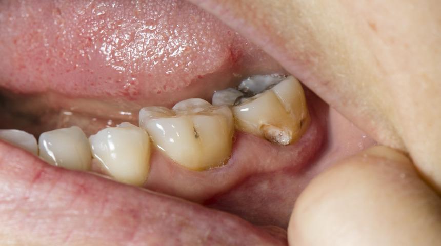 Ağız ve diş sağlığı için bu yiyecek ve içeceklere dikkat