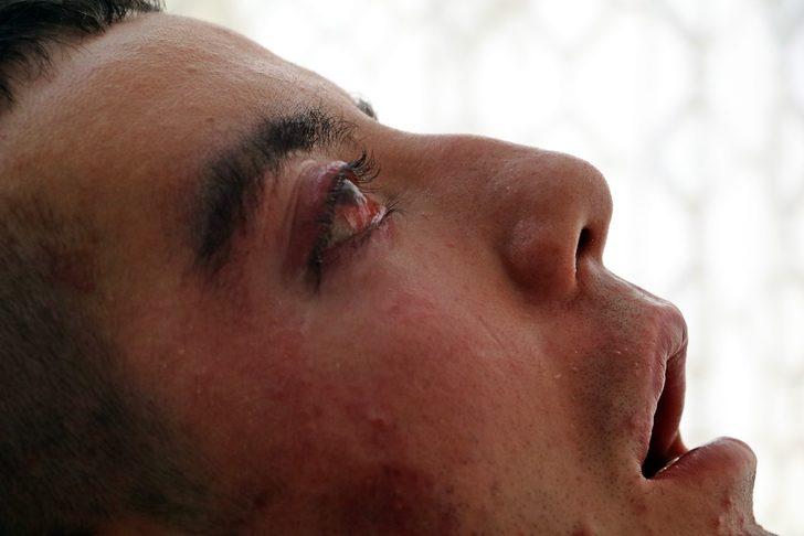 5 yıldır gözlerini kırpamıyor, adeta kan ağlıyor G1