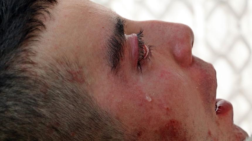 Kesin tedavisi yok... 5 yıldır gözlerini kırpamıyor, adeta kan ağlıyor