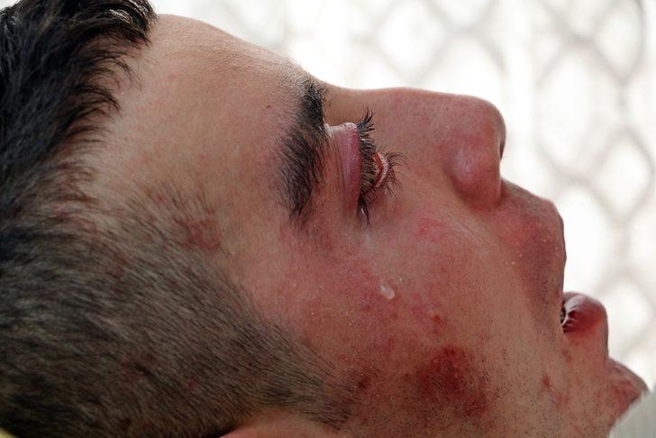 5 yıldır gözlerini kırpamıyor, adeta kan ağlıyor G3