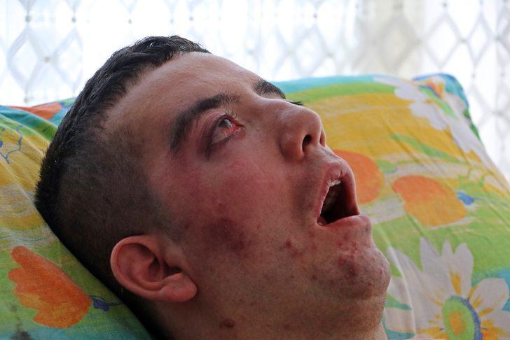 5 yıldır gözlerini kırpamıyor, adeta kan ağlıyor G5