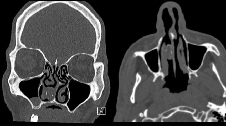 Burnunun ucundaki esrarı 18 yıl sonra fark etti