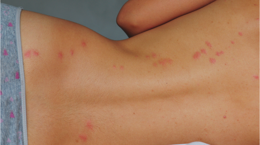 V&uuml;cudunuzdaki ısırıklar tahta kurusundan kaynaklanıyor olabilir! Evinizdeki bu yerleri devamlı kontrol edin 