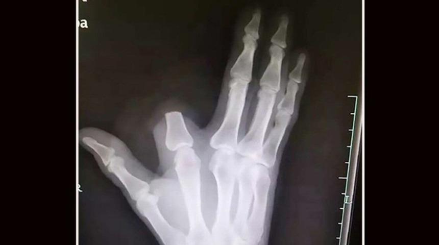 Yılan sokunca parmağını kesti! Kötü haberse hastanede geldi