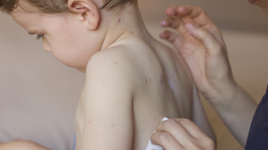 Kızamık vücuda enfeksiyonla mücadeleyi unutturuyor