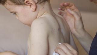 Kongo Demokratik Cumhuriyeti'nde bu yıl 5 bin 110 kişi kızamıktan öldü