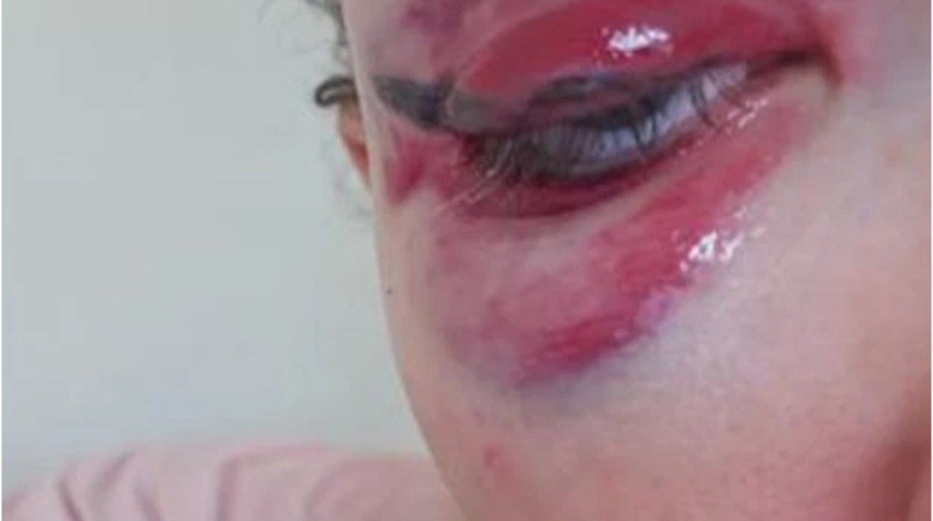 Korku filminden bir sahne gibi! Kalıcı makyaj yaptırayım derken gözünden oluyordu