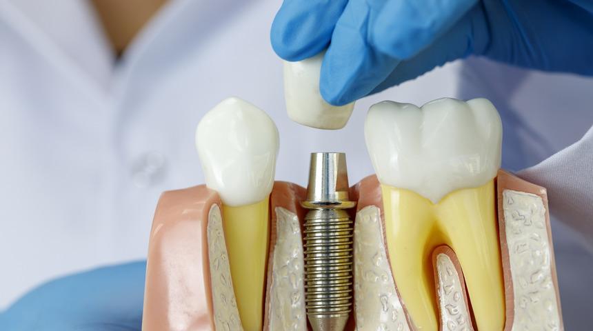 Diş implantı yaptırmadan önce bilmeniz gereken 10 önemli madde