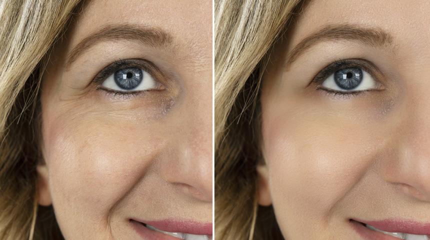 ​Yeni trend: Ameliyatsız g&ouml;z &ccedil;evresi estetiği 