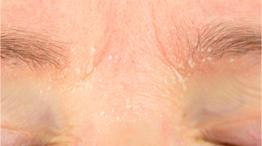 &Ccedil;alışmayan tiroid cilt kuruluğu yapıyor