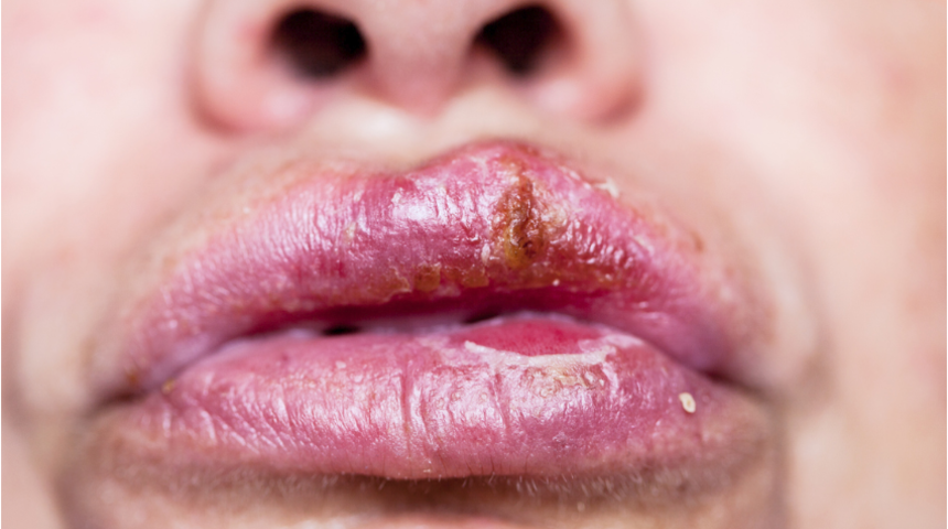 &Ouml;p&uuml;şmeyle bulaşan hastalıklar bağışıklık sistemini zayıflatıyor