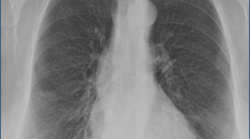 X-ray'den geçerken fark edildi! Midesinden çıktı