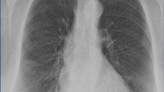 X-ray'den geçerken fark edildi! Midesinden çıktı