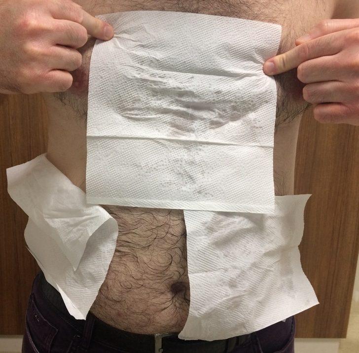 Literatüre girecek ameliyatla aşırı terlemeye çözüm G4