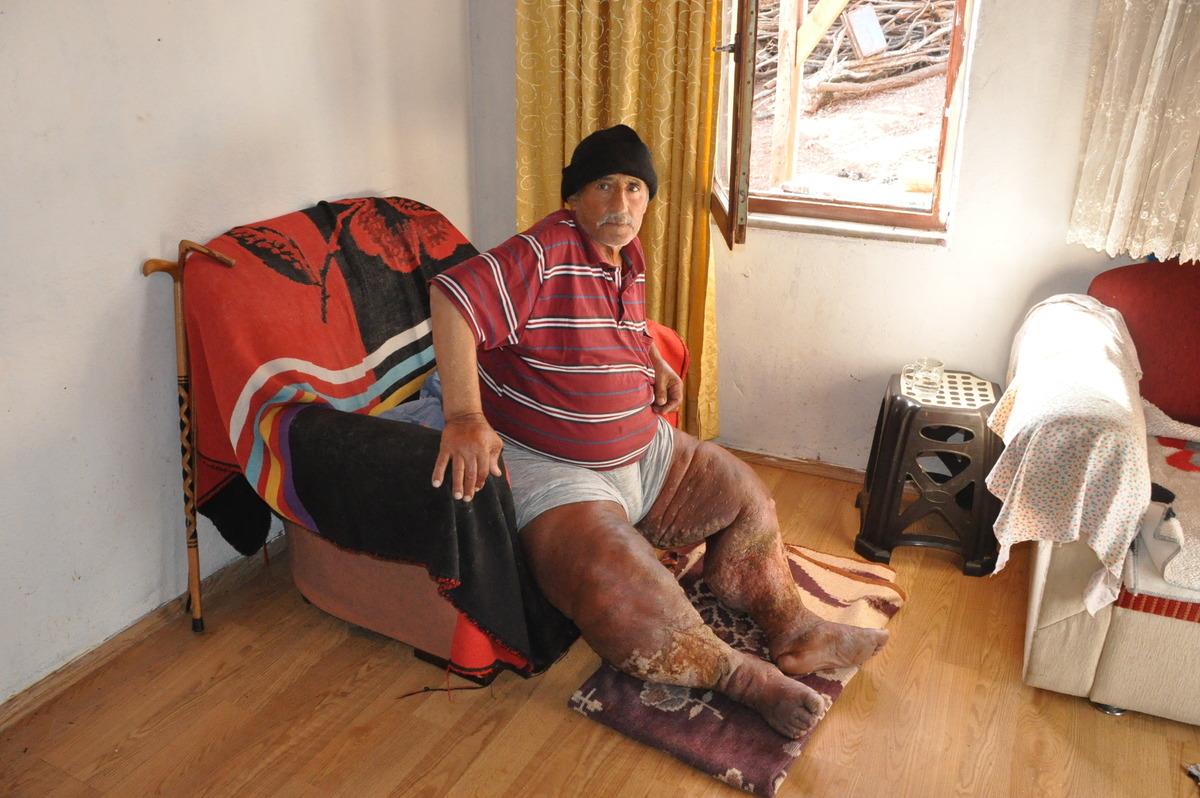 Fil hastası adamın hali y&uuml;rek dağladı: Dayanacak g&uuml;c&uuml;m kalmadı