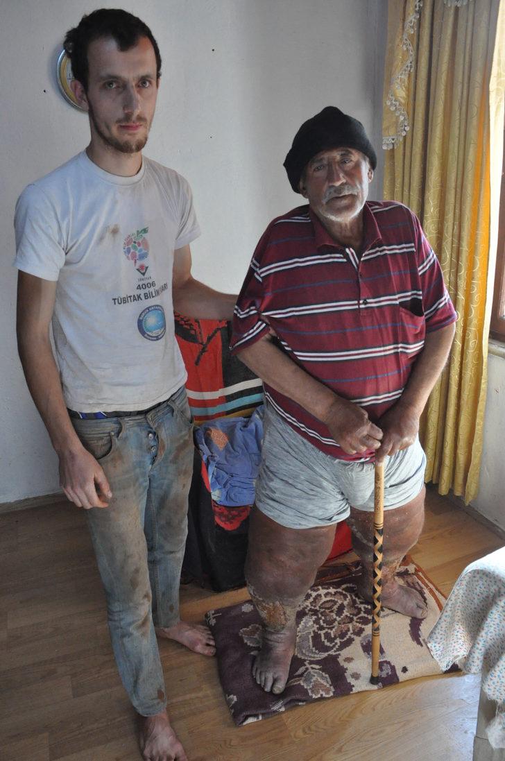 Fil hastalığı bacaklarını yok ediyor Son Dakika Haberler