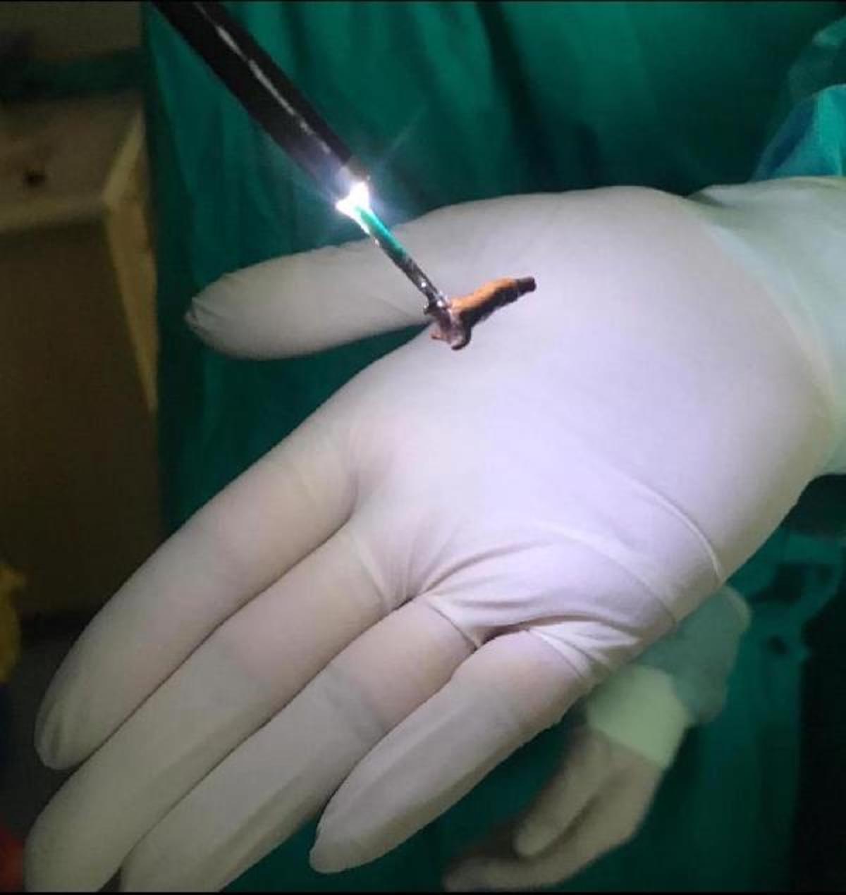 Solunum g&uuml;&ccedil;l&uuml;ğ&uuml; şikayetiyle hastaneye gitti! Akciğerinden karanfil &ccedil;ıktı