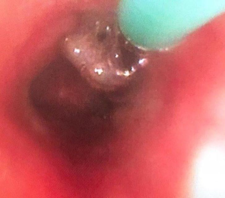 Çiğnediği karanfil akciğerine kaçınca ölümden döndü G3