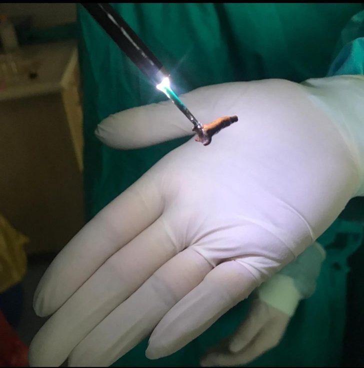 Çiğnediği karanfil akciğerine kaçınca ölümden döndü G5