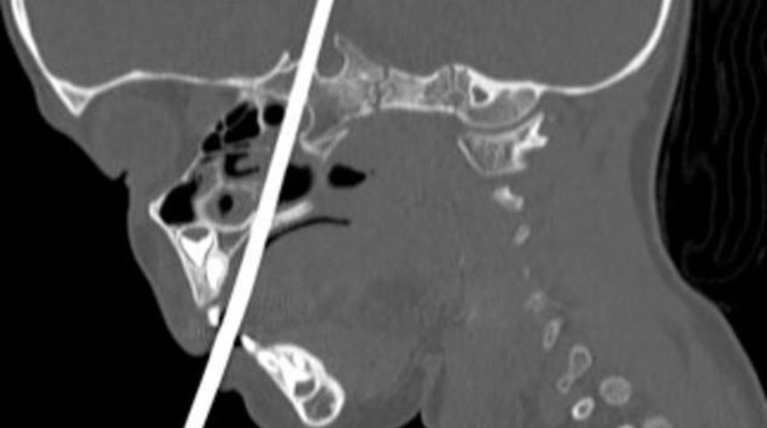 Kafatasına şiş saplandı, mucize eseri hayatta kaldı!