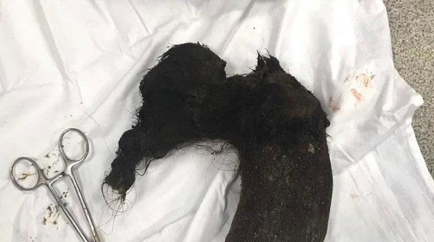 10 yıl boyunca yediği saçları ameliyatla midesinden çıkarıldı