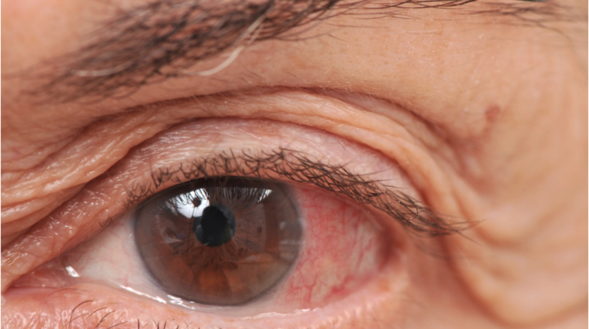 G&ouml;zlerde oluşan fazla yağ yorgun g&ouml;r&uuml;nt&uuml;ye neden oluyor