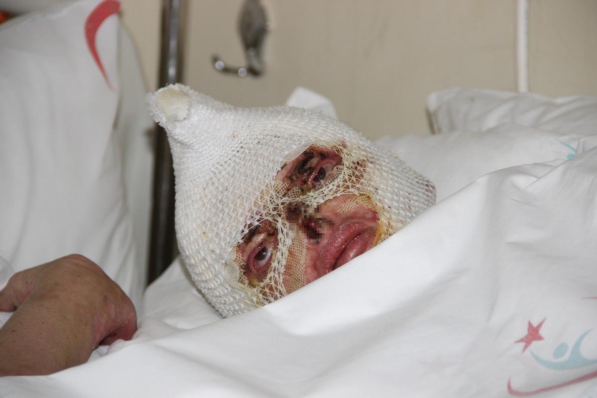 1 saat boyunca alevlerin i&ccedil;inde kaldı! Mutfaktan &ccedil;ıkarıldığında tanınmaz haldeydi