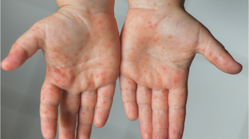 Çocuklarda el, ayak, ağız hastalığı! Bu belirtiler alarm veriyor