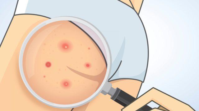 Dar pantolon ve etek kalçada sivilceye neden olabilir! Peki nasıl kurtulacaksınız?