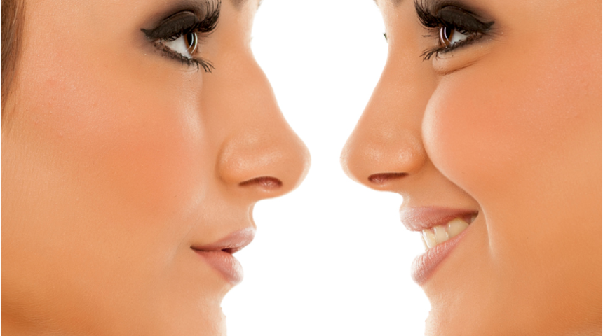 Küçük mü kalkık mı? Burun estetiği yaptıracaksanız eğer bu noktalara dikkat edin 
