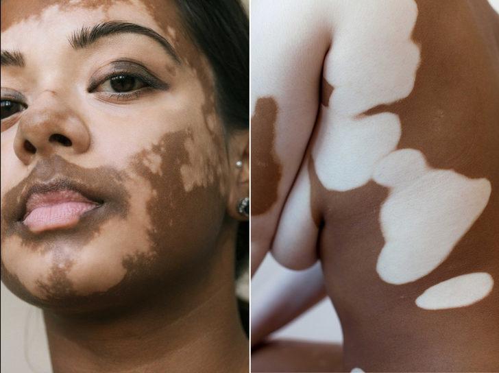 Vitiligo projesi! 'Tüm görkemiyle vitiligoyu kutluyoruz' G1