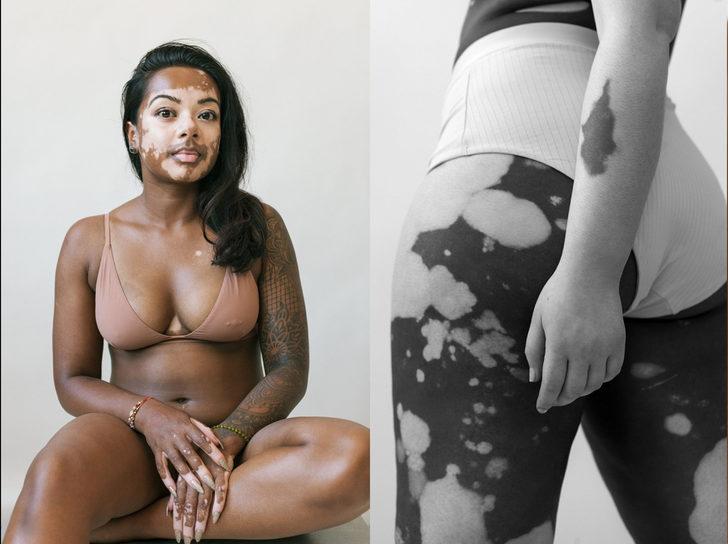 Vitiligo projesi! 'Tüm görkemiyle vitiligoyu kutluyoruz' G2