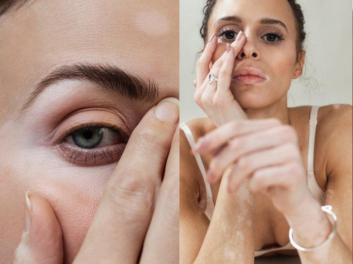 Vitiligo projesi! 'Tüm görkemiyle vitiligoyu kutluyoruz' G3