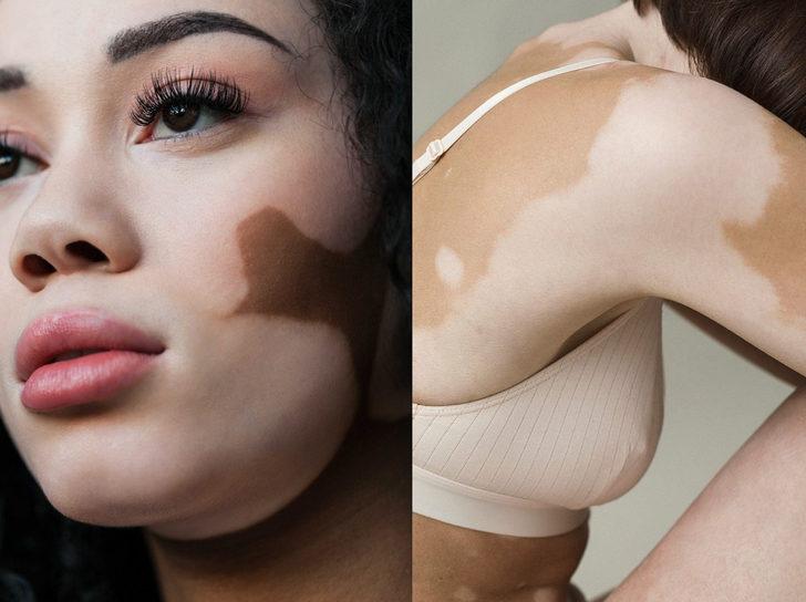 Vitiligo projesi! 'Tüm görkemiyle vitiligoyu kutluyoruz' G4