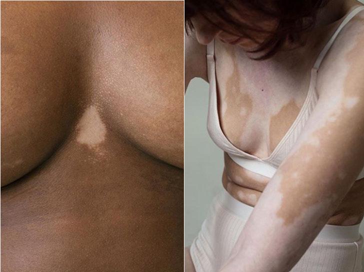 Vitiligo projesi! 'Tüm görkemiyle vitiligoyu kutluyoruz' G5