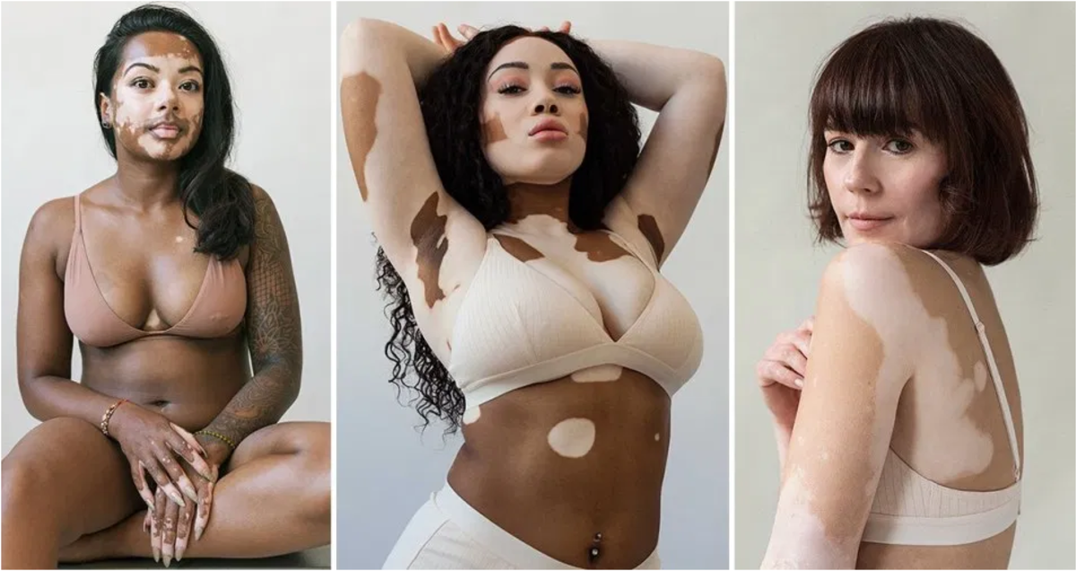 Vitiligo projesi! 'T&uuml;m g&ouml;rkemiyle vitiligoyu kutluyoruz'