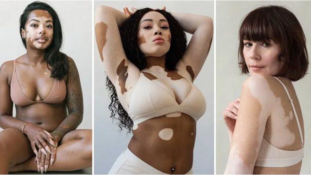 Vitiligo projesi! 'Tüm görkemiyle vitiligoyu kutluyoruz'