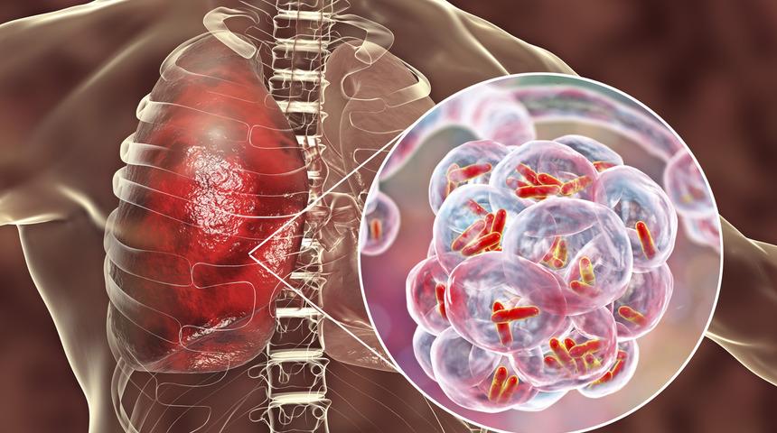 Akciğerleri temizlemek için en etkili detoks