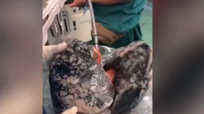 30 yıldır sigara içen kişinin akciğeri 25 milyon kez izlendi!