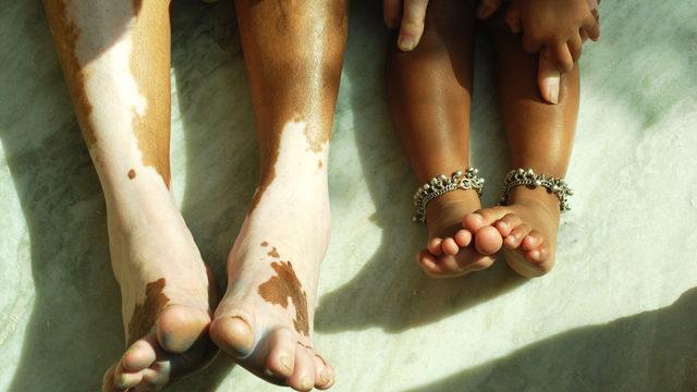 Gebelik ve emzirme döneminde vitiligo tedavisi nasıl planlanır?