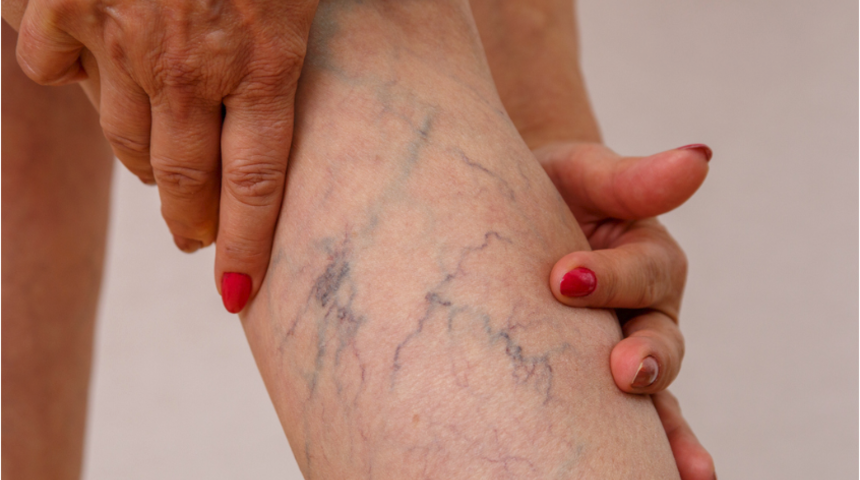 Varis nasıl tedavi edilir?