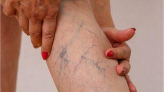 Varis nasıl tedavi edilir?