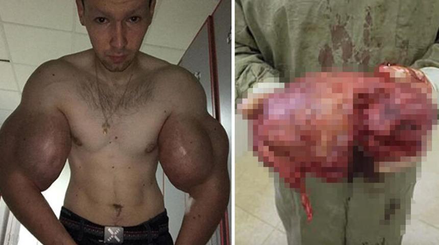 Ve ameliyat masasına yattı! Kolundan bu çıktı