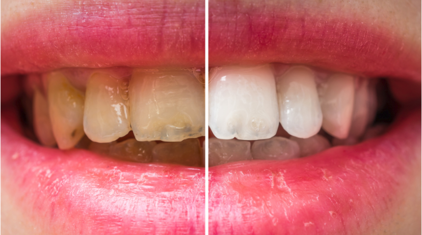 Diş beyazlatma yaptırırken dikkat! Ya profesyonel bir beyazlatma yaptırın ya da hiç yaptırmayın