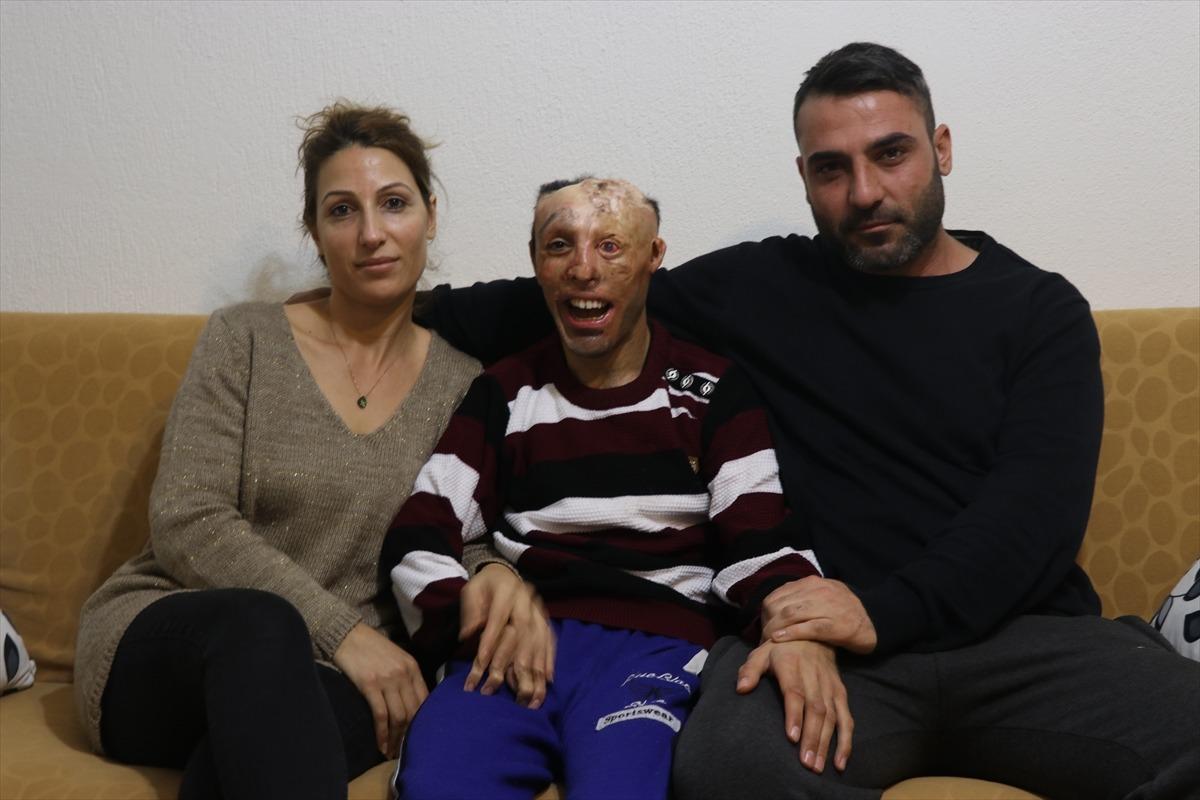 V&uuml;cudu &ccedil;ocukken yanan gence Sağlık Bakanlığından tedavi desteği