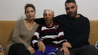 Vücudu çocukken yanan gence Sağlık Bakanlığından tedavi desteği