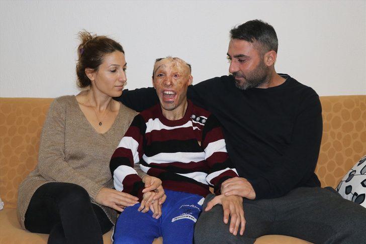 Vücudu çocukken yanan gence Sağlık Bakanlığından tedavi desteği G2