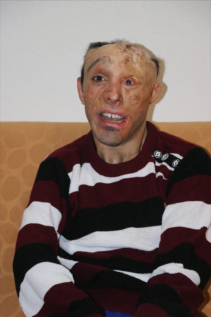 Vücudu çocukken yanan gence Sağlık Bakanlığından tedavi desteği G3