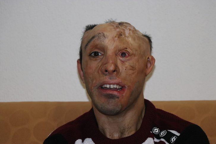 Vücudu çocukken yanan gence Sağlık Bakanlığından tedavi desteği G4